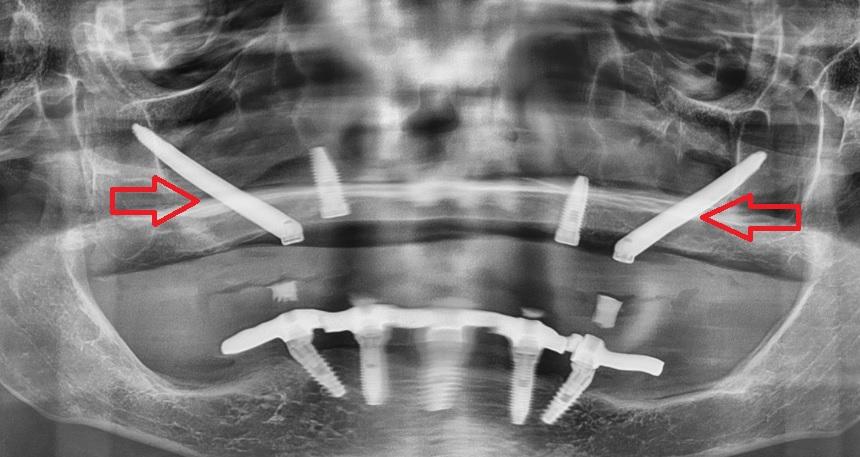 Implante Zigomático: Uma Solução Inovadora para Casos Complexos